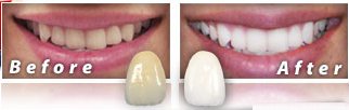 Idol White Teeth Whitening Review Before After